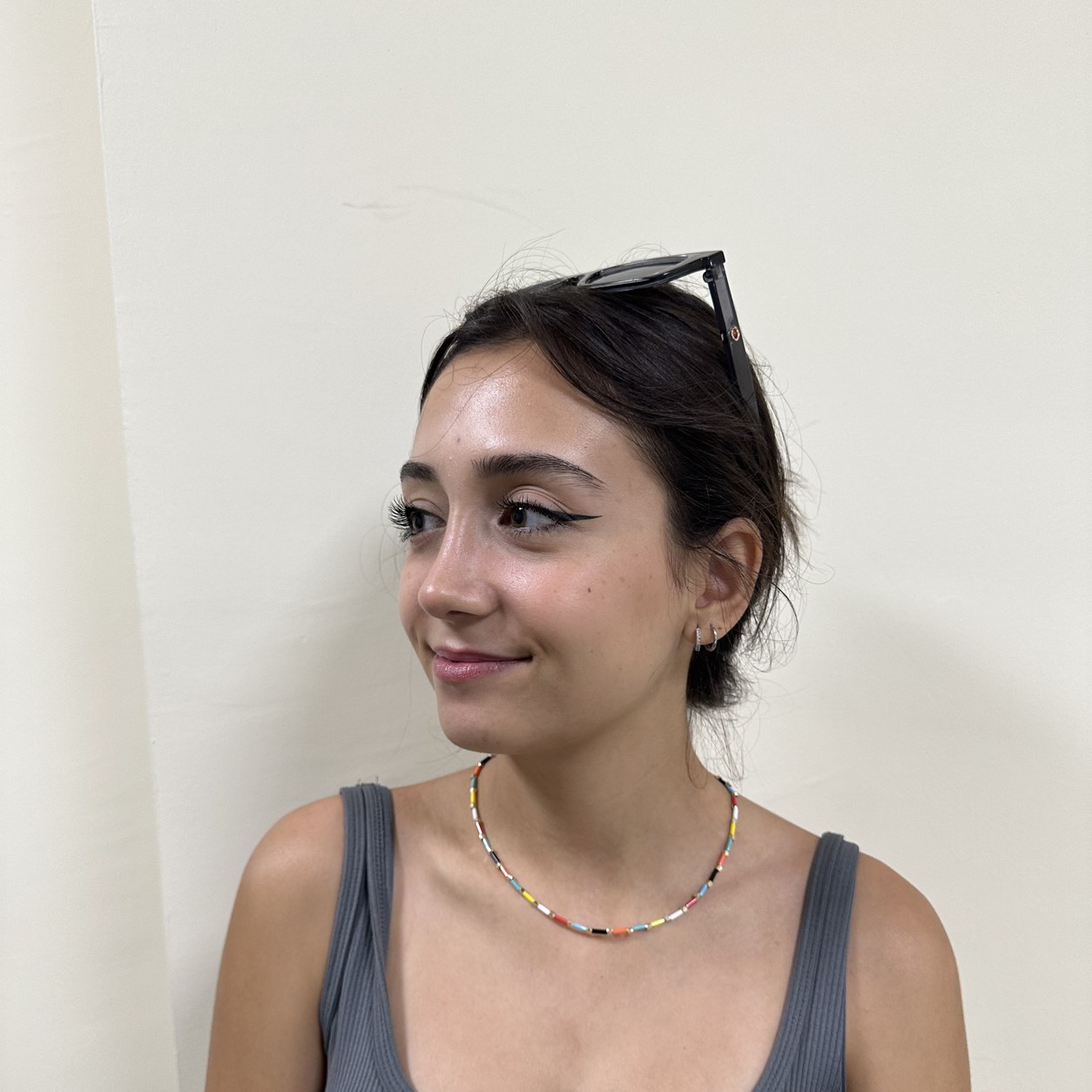 Rhinoplasty (nose job) after result — Op. Dr. Aytaç Kılıç, Antalya