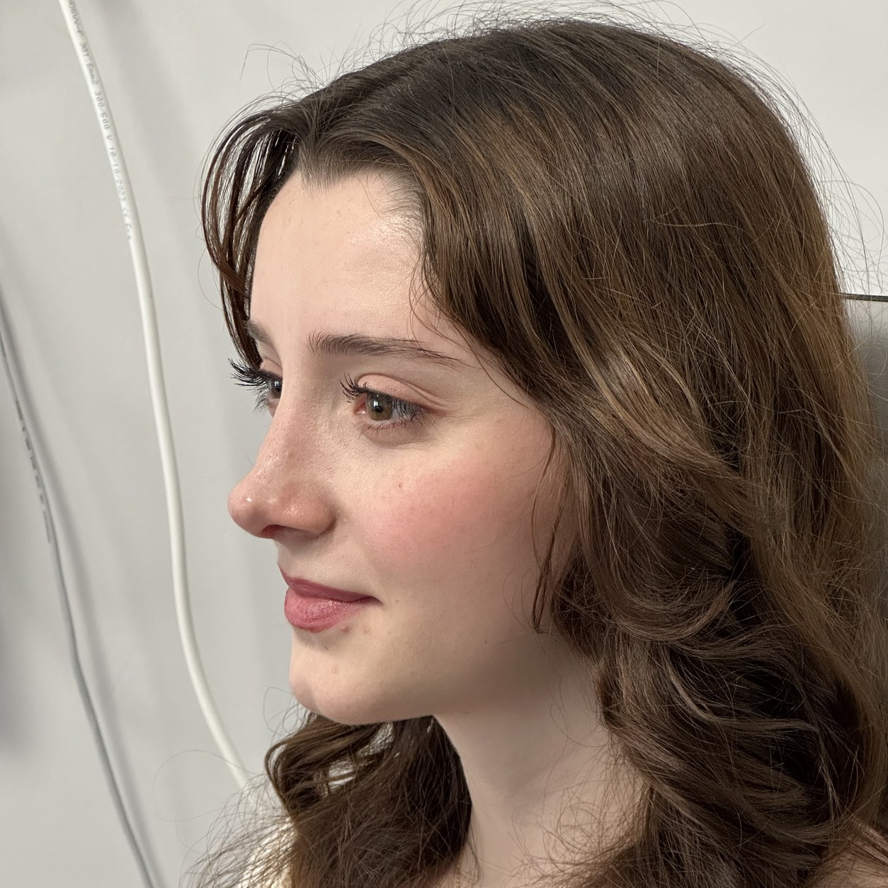 Rhinoplasty (nose job) after result — Op. Dr. Aytaç Kılıç, Antalya