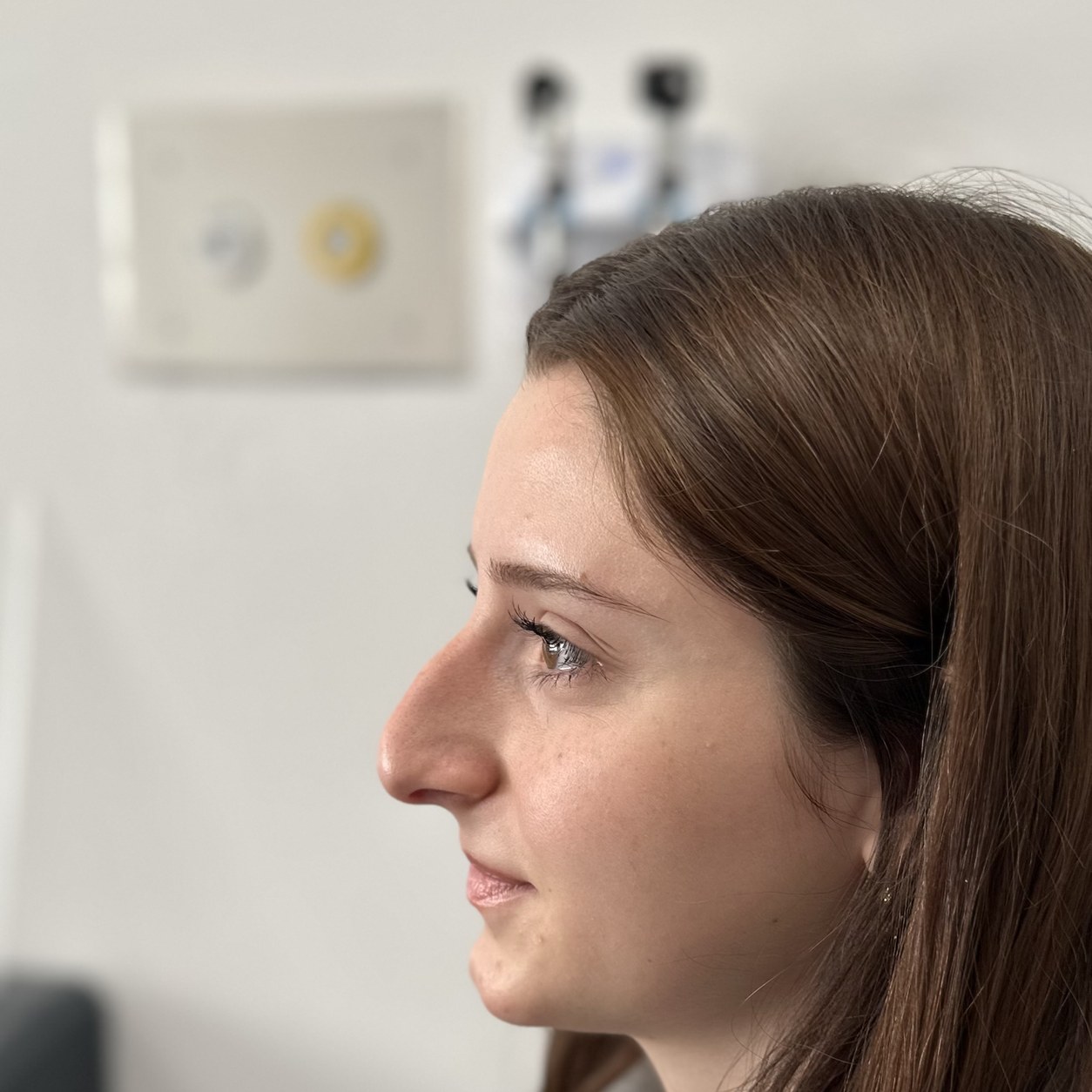 Rhinoplasty (nose job) before photo, profile view — Op. Dr. Aytaç Kılıç, Antalya