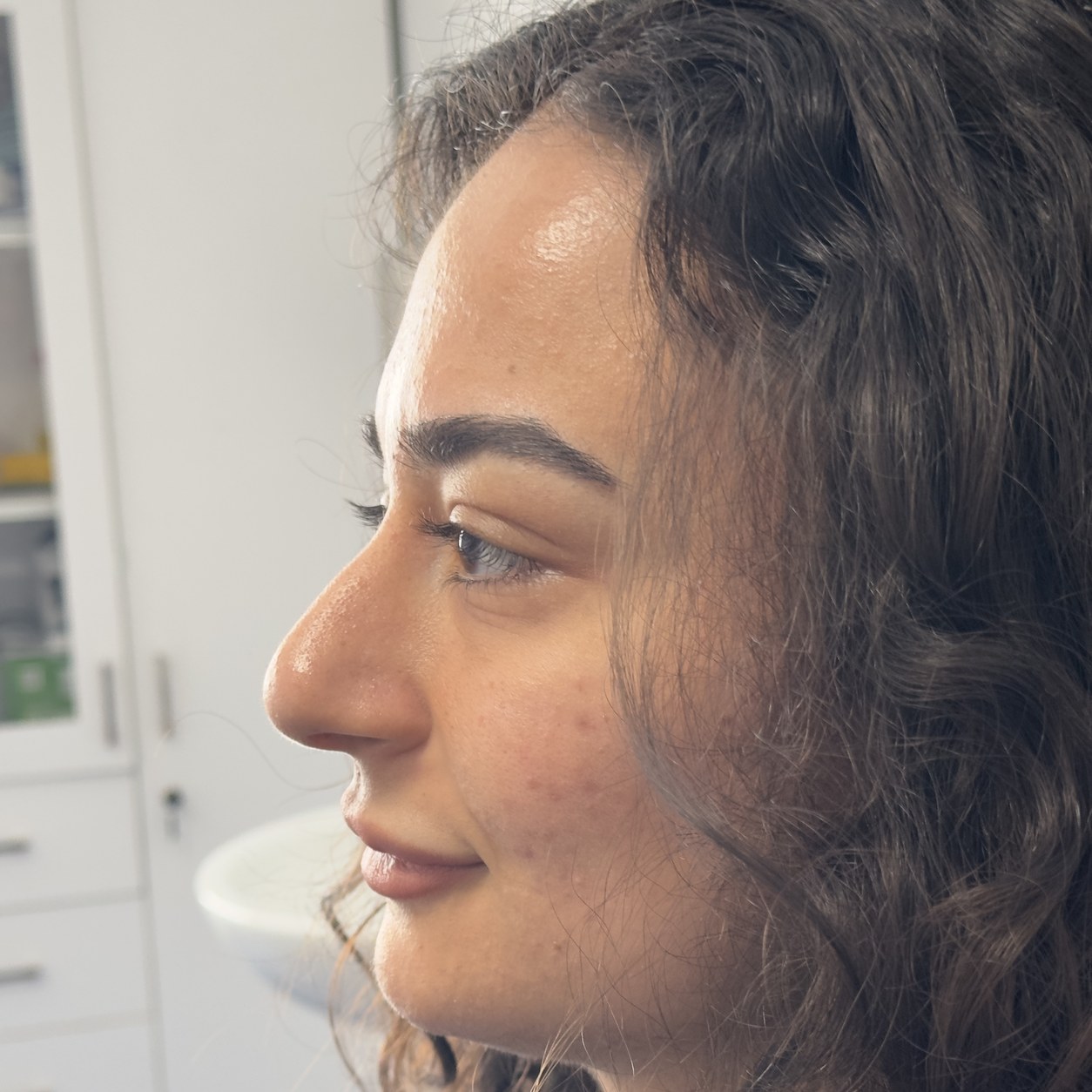 Rhinoplasty (nose job) before photo, profile view — Op. Dr. Aytaç Kılıç, Antalya