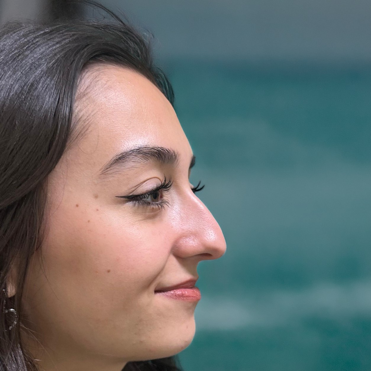Rhinoplasty before photo, profile view — Op. Dr. Aytaç Kılıç, Antalya
